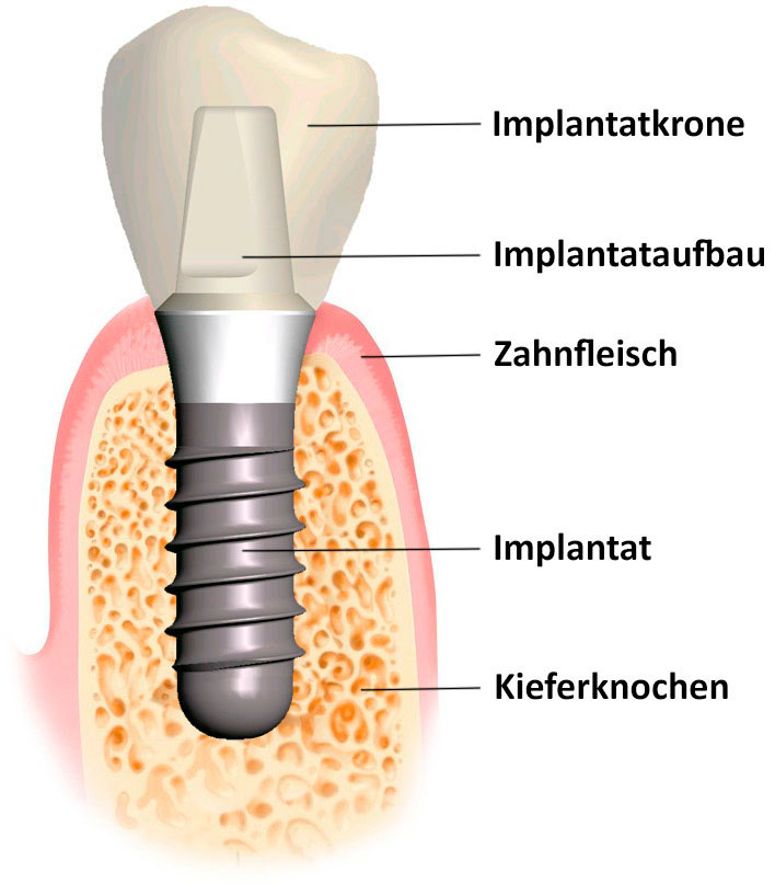 Implantate, Zahnimplantate: Aufbau eines Zahnimplantats