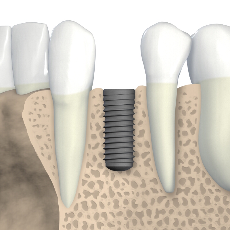 Einige Hersteller geben eine lebenslange Garantiezeit für Implantate