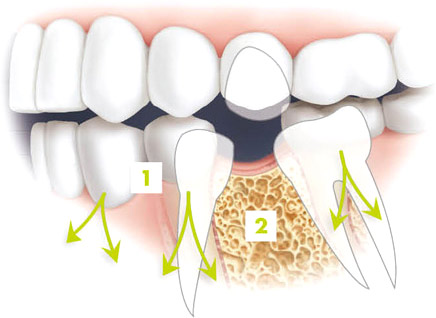 Auswirkungen des Zahnverlusts auf den Kieferknochen