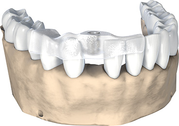 Präzise Implantatplatzierung und Schutz der umliegenden Strukturen und des Nerves.