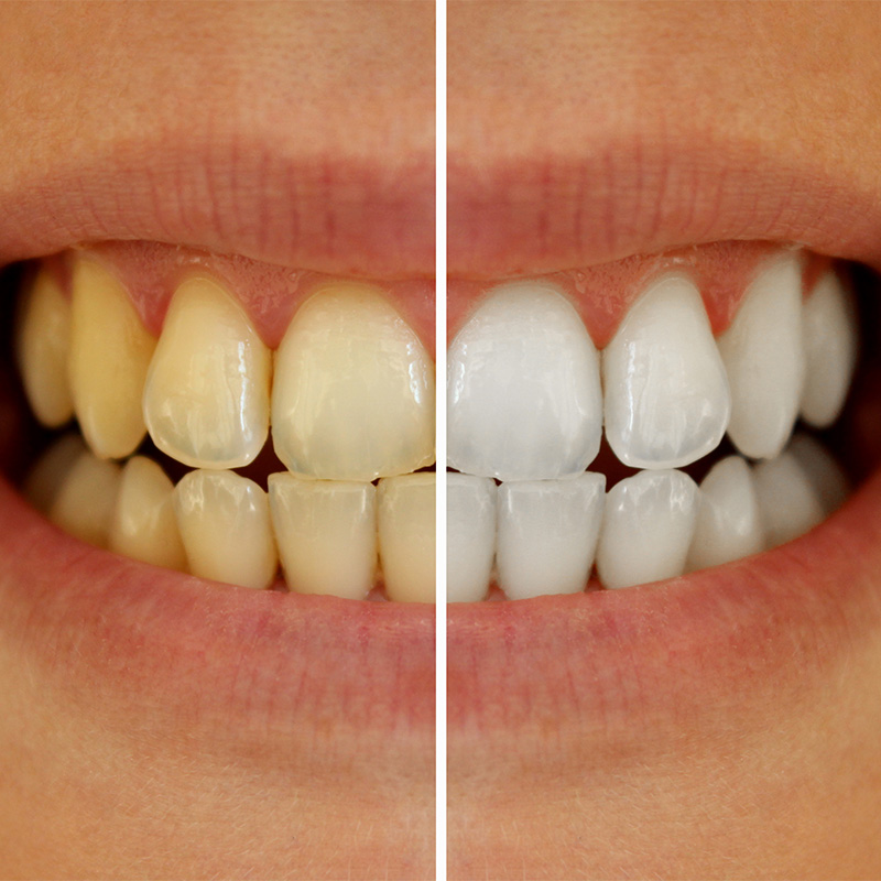 Bleaching eignet sich zur Behandlung einzelner Zähne oder auch der gesamten Zahnreihe. 