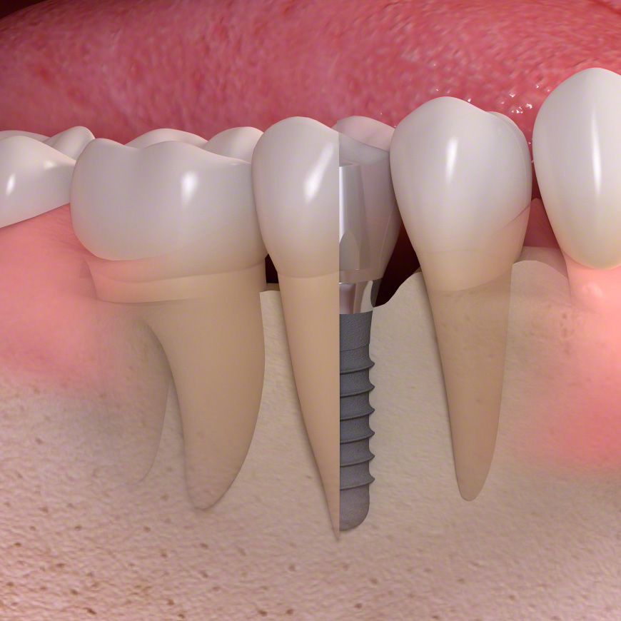 Implantate aus Titan: guenstiges Titan Zahnimplantat