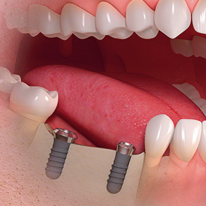 Mehrere fehlende Zähne durch Implantate ersetzt