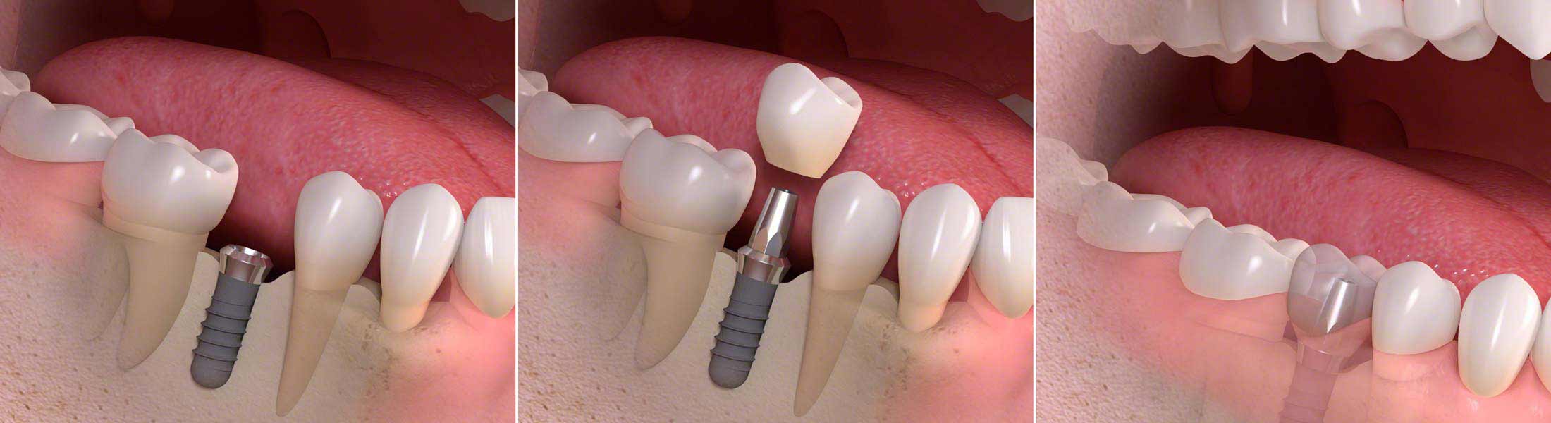 Einsetzten eines einzelnen Zahnimplantats