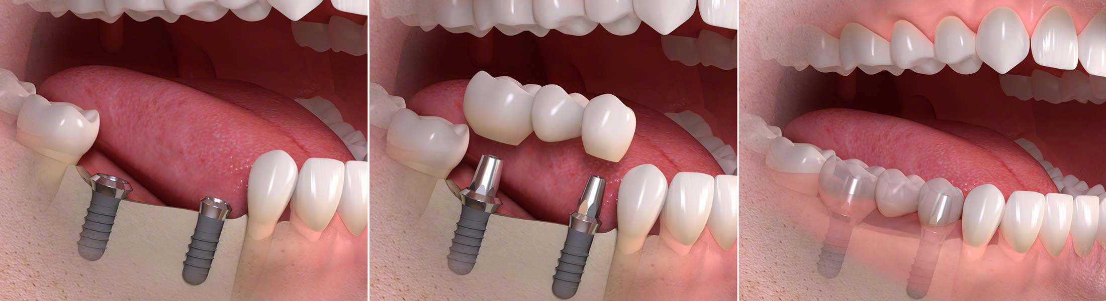 Mehrere Zähne durch Implantate ersetzt
