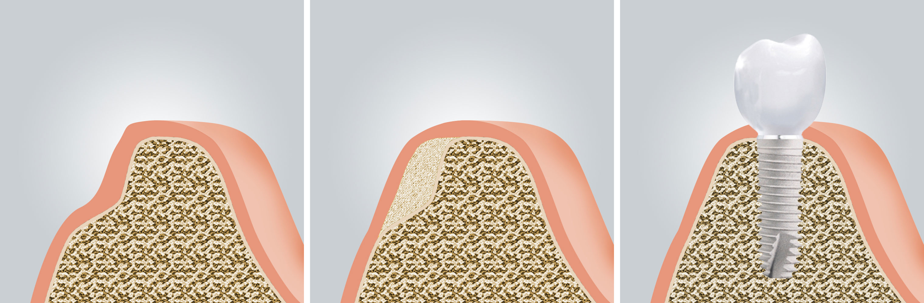 Knochenaufbau mit Eigenknochen