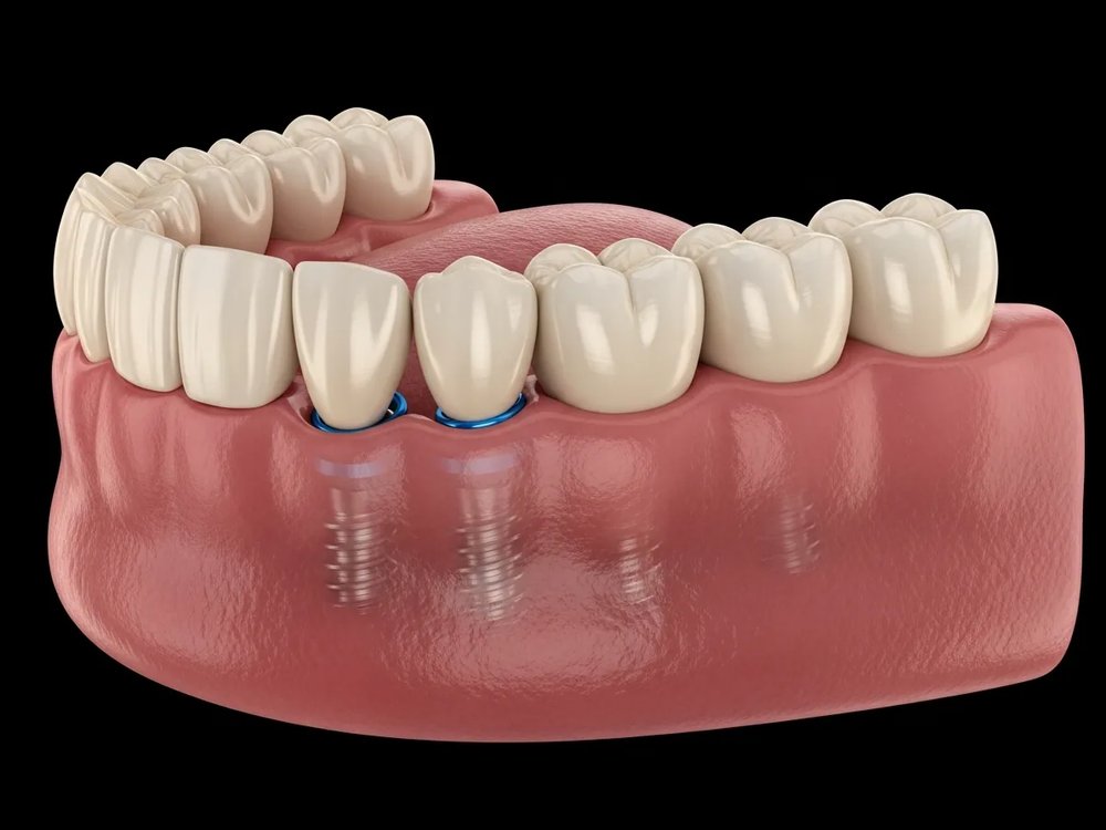 Dişsiz alt &ccedil;enede d&ouml;rt eğimli implant, eğik g&ouml;r&uuml;n&uuml;m