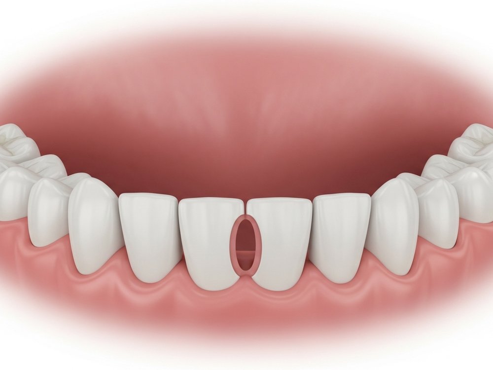 An empty socket in the upper jaw after extraction, schematic view