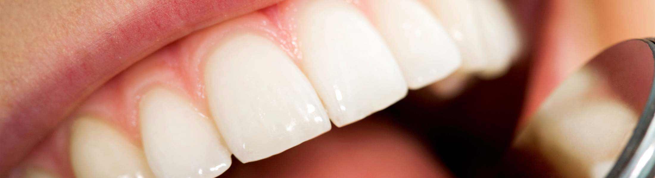 Das Eingliedern des implantatgetragenen Zahnersatzes