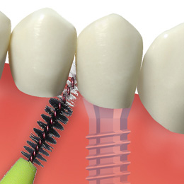 Mechanische Säuberung eines Implantates mit einer speziellen Titanbürste