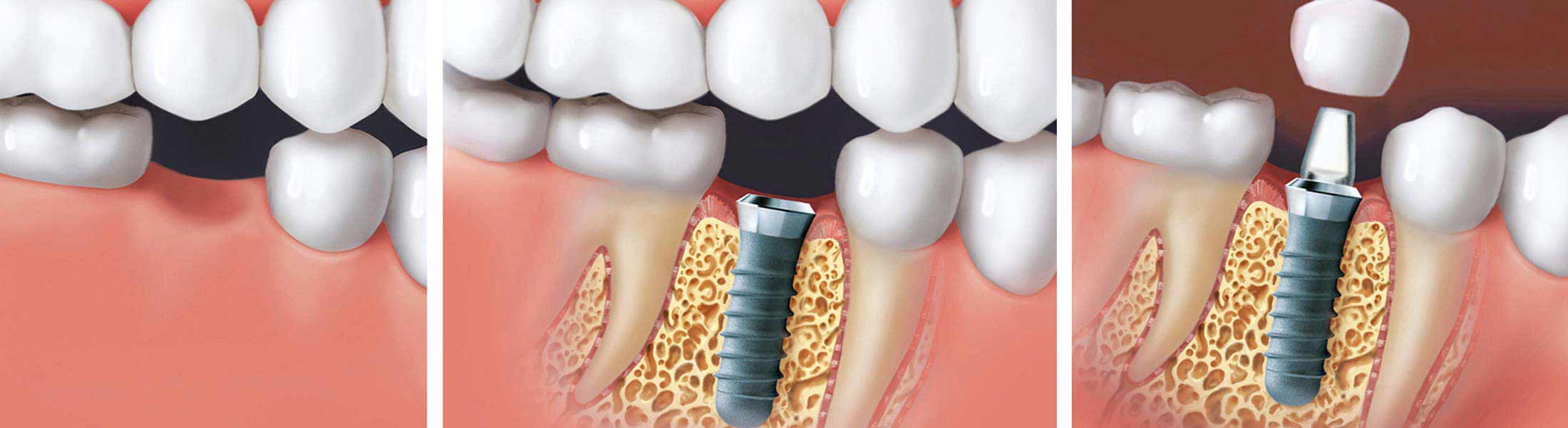 Ablauf einer dentalen Implantation