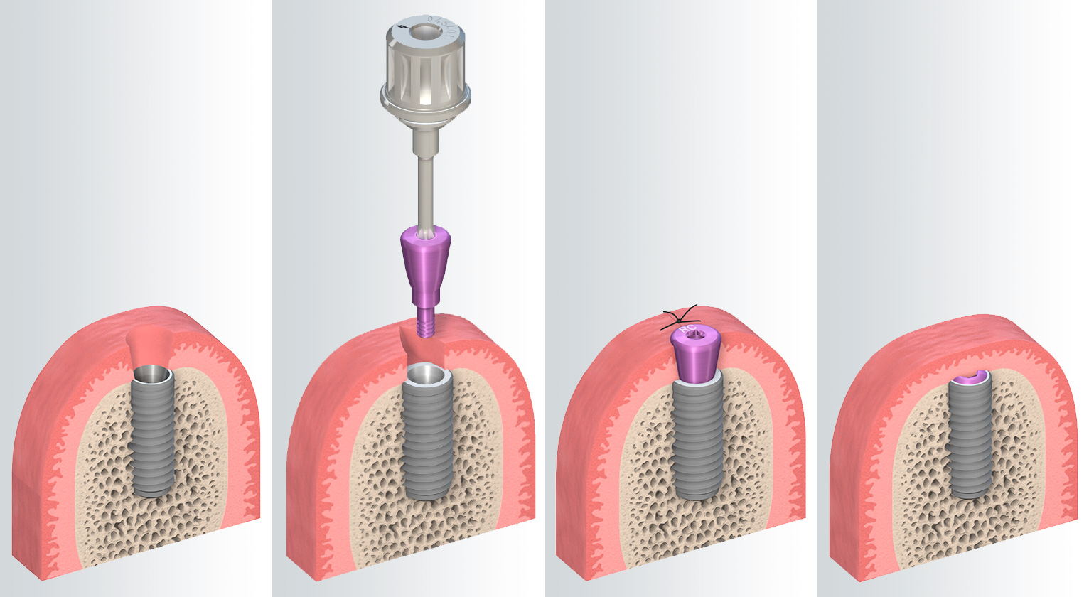 die gedeckte Einheilung des Implantates bietet mehr Schutz währen des Heilprozesses